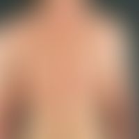 Generalized atopic eczema: Exacerbated, generalized seizure-like itchy dermatitis with multiple, ...