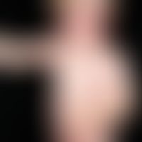 eczema, atopic (nummular atopic eczema). findings persisting since the 1st month of life in a now...