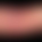 Atopic eczema with emphasis on flexion: Skin lesions in a 16-year-old girl with intermittent cour...