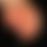 Eczema, atopic. chronic, recurrent itchy red spots and slightly raised, flat, rough red plaques o...