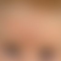 Dermatitis, atopische: chronische, rezidivierend auftretende, juckende, rote Flecken sowie leicht...