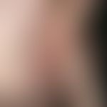 Eczema, atopic. 18-year-old female patient with recurrent retroauricular, strongly itchy, reddish...