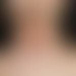 Eczema, atopic. brownish, dry, scaly plaques on lichenified ground in the neck area of a 24-year-...