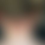 Eczema, atopic. solitary, chronically stationary, now acutely weeping (superinfection), blurred, ...