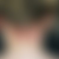Eczema, atopic. solitary, chronically stationary, now acutely weeping (superinfection), blurred, ...