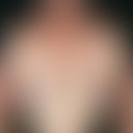 Intrinsic atopic eczema. exacerbated clinical picture with multiple, chronically dynamic, symmetr...