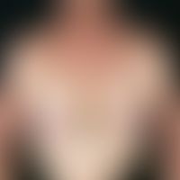 Intrinsic atopic eczema. exacerbated clinical picture with multiple, chronically dynamic, symmetr...