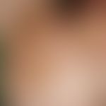 Eczema, atopic. blurredly limited, large-area, dry, bran-like scaling, brownish, rough plaques on...