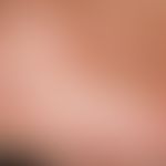 Dyshidrotische Dermatitis:&nbsp;dichtstehende, teils solitäre, teils konfluierte Bläschen und Pus...
