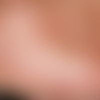 Dyshidrotische Dermatitis:&nbsp;dichtstehende, teils solitäre, teils konfluierte Bläschen und Pus...