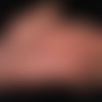 Dyshidrotische Dermatitis:&nbsp;Beide Handflächen betreffende, chronisch rezidivierende, teils ve...