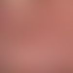 Dyshidrotische Dermatitis:&nbsp;Detailausschnitt: Stark ausgeprägte, hyperkeratotische Hautveränd...