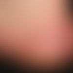 Dyshidrotische Dermatitis:&nbsp;chronisch rezidivierend auftretende, gering infiltrierte Plaques ...