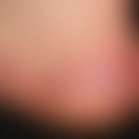 Dyshidrotische Dermatitis:&nbsp;chronisch rezidivierend auftretende, gering infiltrierte Plaques ...