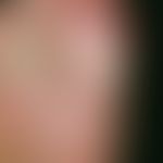 Dyshidrotische Dermatitis:&nbsp;multiple, an der Großzehe akut aufgetretene, klare Bläschen und B...