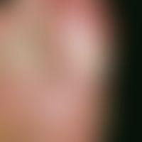 Eczema, dyshidrotic. multiple, acutely occurring clear blisters and blisters on the big toe with ...