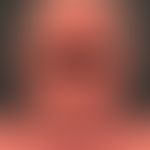 Eczema, atopic photoaggravated: Chronic persistent eczema that has existed for 2 years and exacer...