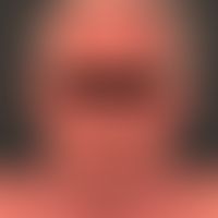 Eczema, atopic photoaggravated: Chronic persistent eczema that has existed for 2 years and exacer...