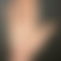 Eczema, hyperkeratotic-rhagadiform eczema of the hand and foot; blurred hyperkeratotic eczema in ...