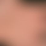 Ekzem, hyperkeratotisch-rhagadiformes Hand- und Fußekzem. Übersichtsaufnahme: Vor 3 Jahren erstma...