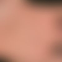 Eczema, hyperkeratotic rhagadiform eczema of the hands and feet. 3-year-old man: 3-year-old man w...