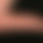 Ekzem, hyperkeratotisch-rhagadiformes Hand- und Fußekzem. Detailvergrößerung: Multiple, vor 3 Jah...