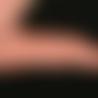 Eczema, hyperkeratotic-rhagadiform eczema of the hands and feet. detail enlargement: multiple, ch...
