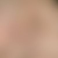 eczema, hyperkeratotic-rhagadiform eczema of the hands and feet. multiple, chronically stationary...