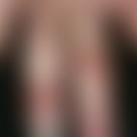 Eczema, hyperkeratotic-rhagadiform hand and foot eczema. chronic, polytopic, blurred, itchy, red,...