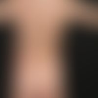 Nummular dermatitis:  General view: Sharply defined, 2-6 cm large, inflammatory reddened, coin-sh...
