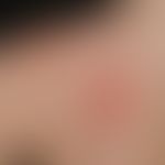 Nummuläre Dermatitis:&nbsp; Detailvergrößerung: Scharf begrenzte, 2-6 cm große, entzündlich geröt...