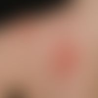 Nummuläre Dermatitis:&nbsp; Detailvergrößerung: Scharf begrenzte, 2-6 cm große, entzündlich geröt...