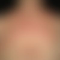 Nummular Dermatitis: General view: For about 6-7 years persistent, strongly itching, solitary or ...