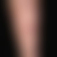 Nummular Dermatitis: General view: For 3 years persistent, itchy, eroded, excoriated, partly encr...
