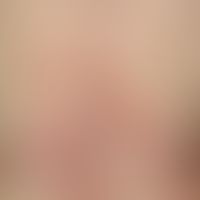 Nummular Dermatitis:  General view: One year ago, for the first time, massive itching, initially ...