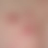 Nummular dermatitis: Detail enlargement : Massive itching, solitary or confluent, scratched, red ...