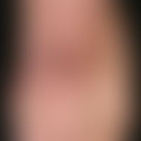 Nummulardermatitis (nummular/microbial eczema): Chronically active, 8-week-old, approx. 6 cm larg...