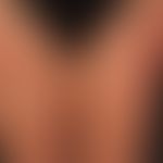 Nummuläre Dermatitis: Seit mehreren Monaten bestehende, ausgedehnte nummuläre Läsionen mit unscha...