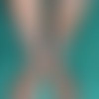 Nummular dermatitis:Extensive nummular lesions that havebeenpresent for several months with blurr...