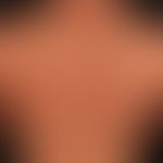 Nummuläre Dermatitis: Seit mehreren Monaten bestehendes, ausgedehntes Ekzem mit unscharf begrenzt...