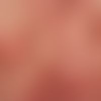 Nummular Dermatitis: Multiple, reddened, confluent, roundish or bizarrely configured plaques with...