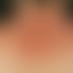 Eczema, photoallergic. seti 6 weeks of unpleasantly itchy and exciting skin lesions. these occurr...