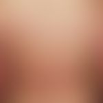 eczema, photoallergic. 51-year-old female patient. generalized skin disease with 0.2-0.4 cm large...