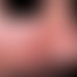 Dermatitis, seborrheic: Therapy-resistant seborrheic eczema in a 32-year-old HIV-infected person....