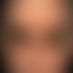 Dermatitis, seborrheic: Chronic, therapy-resistant, psoriasiform seborrheic eczema in a 63-year-o...
