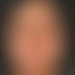 Dermatitis, seborrhoeic. 6-month-old female patient with almost symmetrical, blurred, flatly infi...