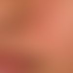 Dermatitis, seborrheic: Blurred, delicately reddened, coarse lamellar scaling, flat, slightly inf...