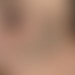 Elastoidosis cutanea nodularis et cystica. Detailvergrößerung der linken Wangen- und Jochbeinregi...