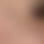 Elastoidosis cutanea nodularis et cystica. Detailvergrößerung der rechten Wangen- und Jochbeinreg...