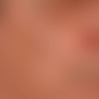 Elastoidosis cutanea nodularis et cystica. elastosis of the skin on the cheeks and periorbital as...